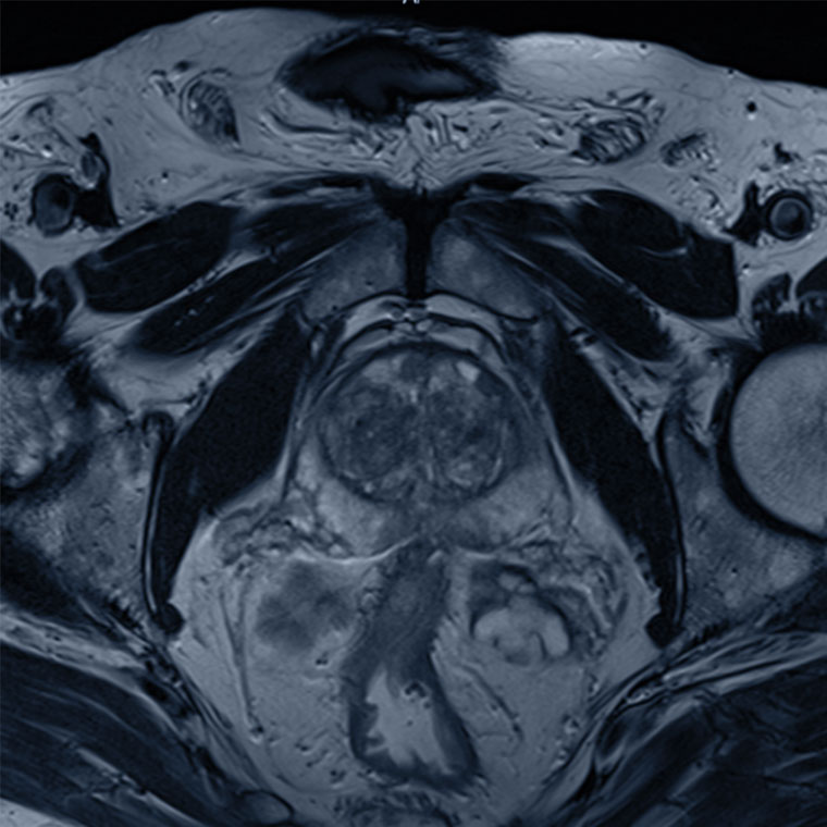 needleye_prostate needleye_prostate